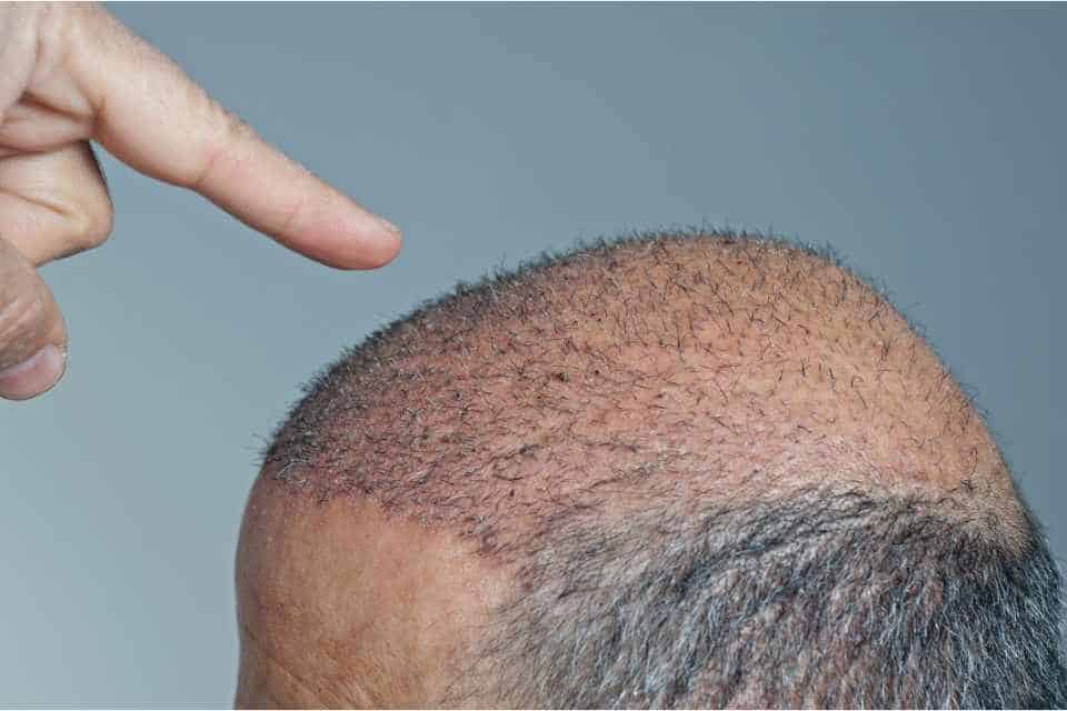 Why Visit Turkey Hair Transplant